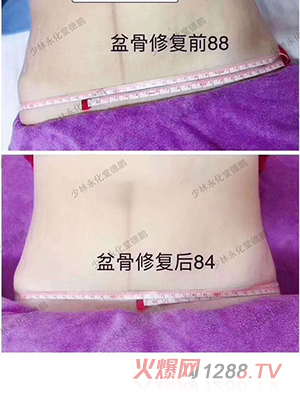 少林永化堂產(chǎn)后項目-骨盆修復